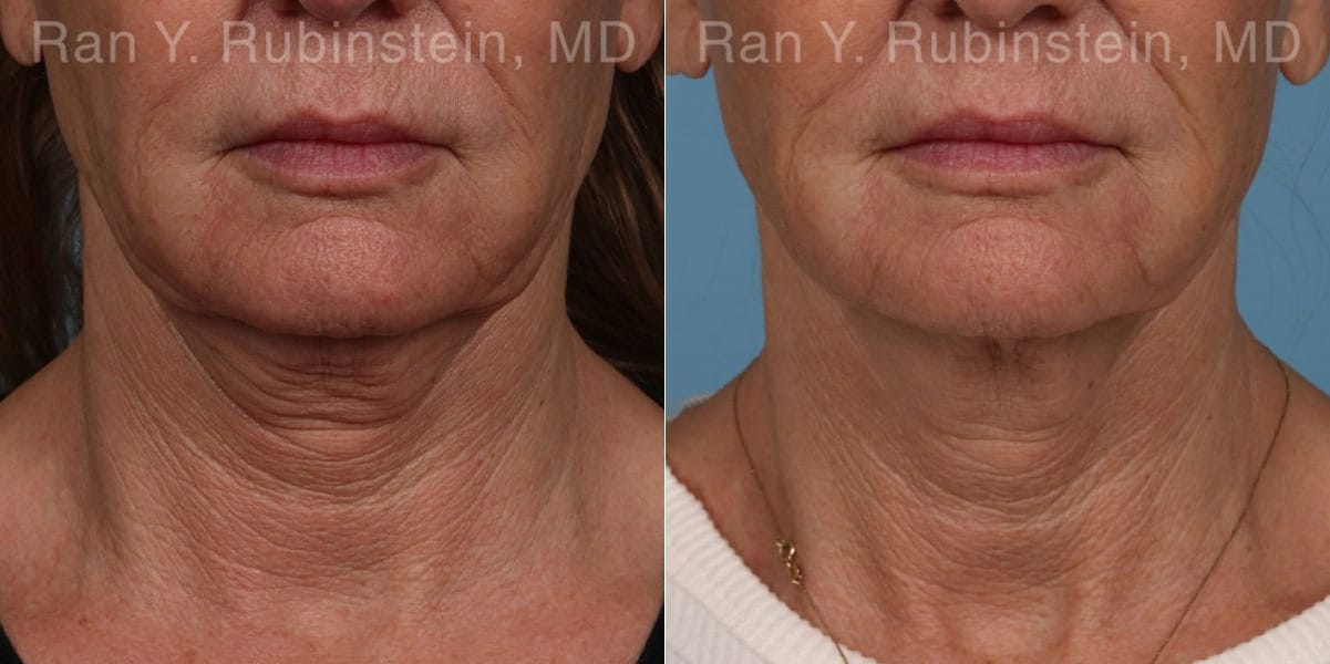 Microneedling RF Before and After Photos in Newburgh, NY, Patient 23835