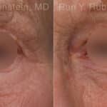 Microneedling RF Before and After Photos in Newburgh, NY, Patient 23843