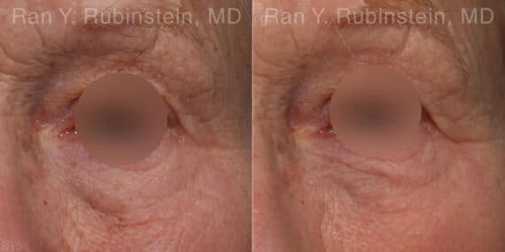 Microneedling RF Before and After Photos in Newburgh, NY, Patient 23843