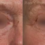 Microneedling RF Before and After Photos in Newburgh, NY, Patient 23843