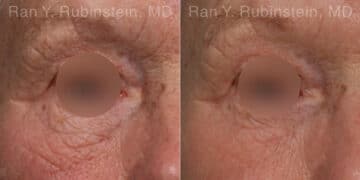 Microneedling RF Before and After Photos in Newburgh, NY, Patient 23843