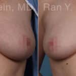 Laser Treatments Before and After Photos in Newburgh, NY, Patient 23851