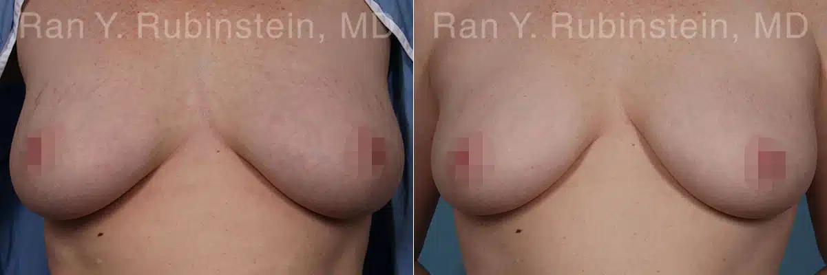 Laser Treatments Before and After Photos in Newburgh, NY, Patient 23851