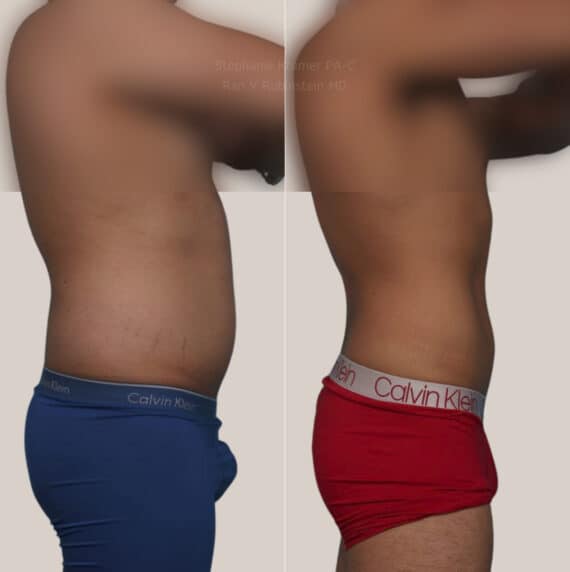 Coolsculpting Elite Before and After Photos in Newburgh, NY, Patient 23927