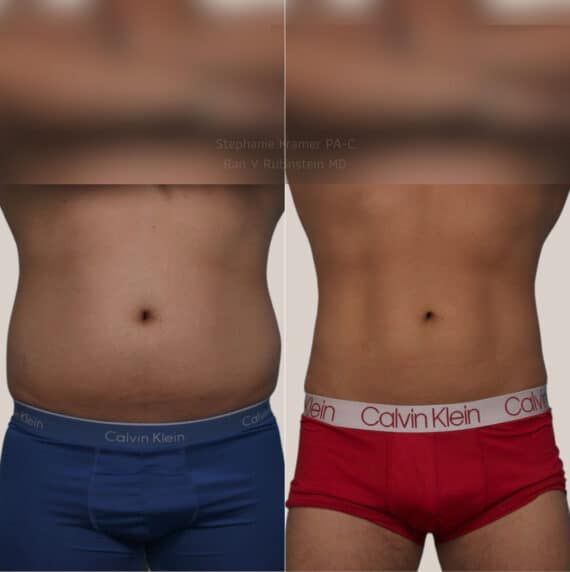 Coolsculpting Elite Before and After Photos in Newburgh, NY, Patient 23927