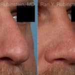 Rhinoplasty Before and After Photos in Newburgh, NY, Patient 23944