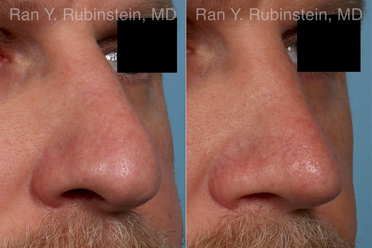 Rhinoplasty Before and After Photos in Newburgh, NY, Patient 23944