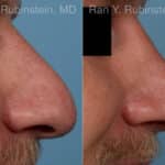 Rhinoplasty Before and After Photos in Newburgh, NY, Patient 23944