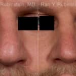 Rhinoplasty Before and After Photos in Newburgh, NY, Patient 23944