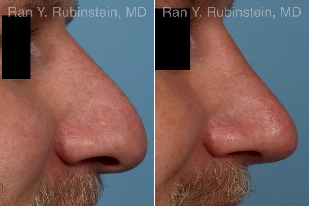 Rhinoplasty Before and After Photos in Newburgh, NY, Patient 23944