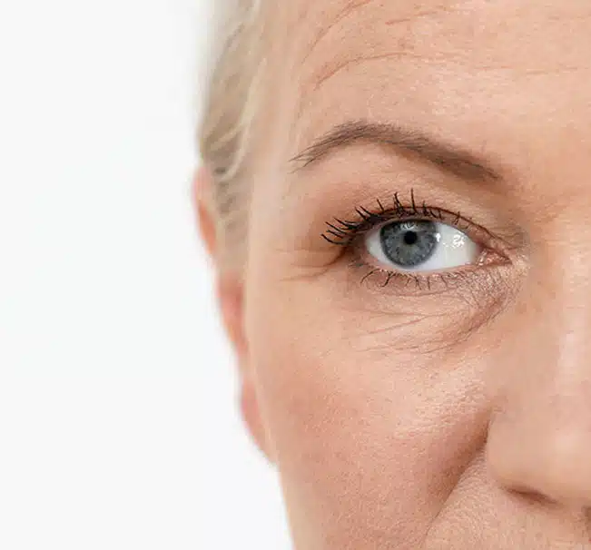 A brow lift is a cosmetic procedure designed to improve the appearance of the upper eyelids