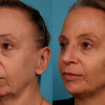 Dermal Fillers Before and After Photos in Newburgh, NY, Patient 24382