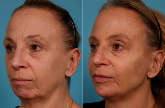 Dermal Fillers Before and After Photos in Newburgh, NY, Patient 24382