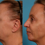 Dermal Fillers Before and After Photos in Newburgh, NY, Patient 24382