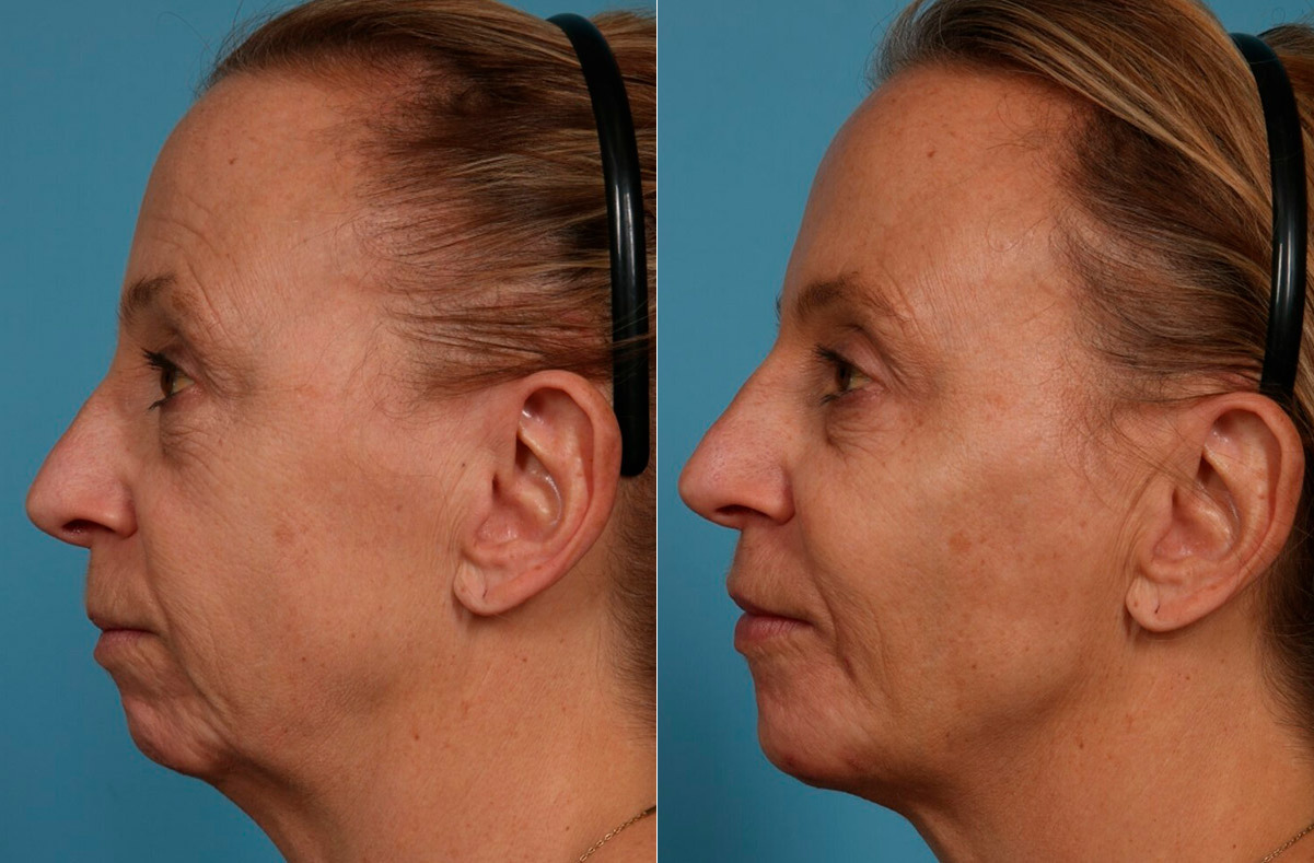 Dermal Fillers Before and After Photos in Newburgh, NY, Patient 24382
