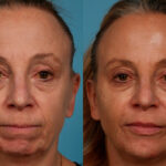 Dermal Fillers Before and After Photos in Newburgh, NY, Patient 24382