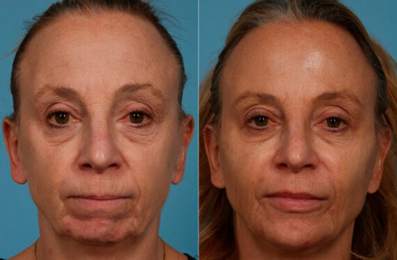 Dermal Fillers Before and After Photos in Newburgh, NY, Patient 24382