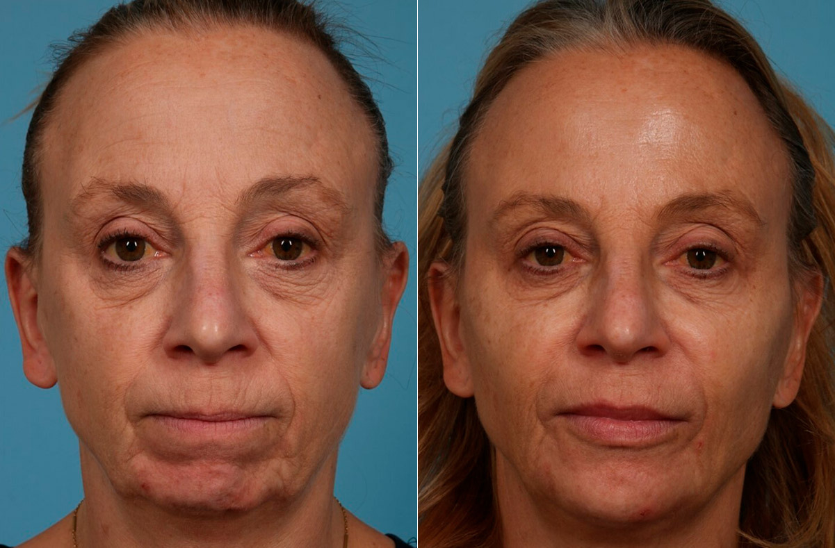 Dermal Fillers Before and After Photos in Newburgh, NY, Patient 24382