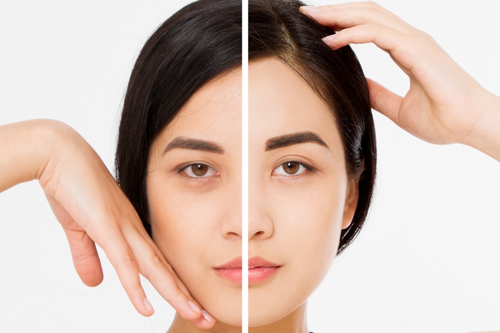 Cost Considerations for Brow Lift: Budgeting Insights