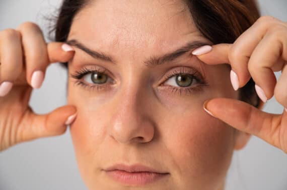 Puckering After Eyelid Surgery What To Expect And What To Do Eyelid Surgery Puckering 00 570x379