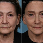 Face lift & Neck lift Before and After Photos in Newburgh, NY, Patient 24509