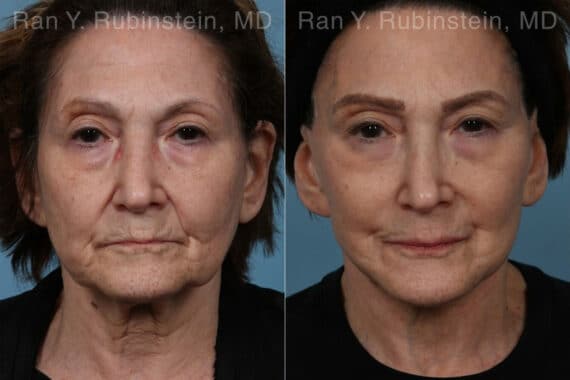 Face lift & Neck lift Before and After Photos in Newburgh, NY, Patient 24509