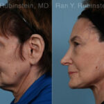 Face lift & Neck lift Before and After Photos in Newburgh, NY, Patient 24509