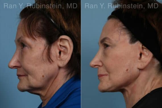 Face lift & Neck lift Before and After Photos in Newburgh, NY, Patient 24509