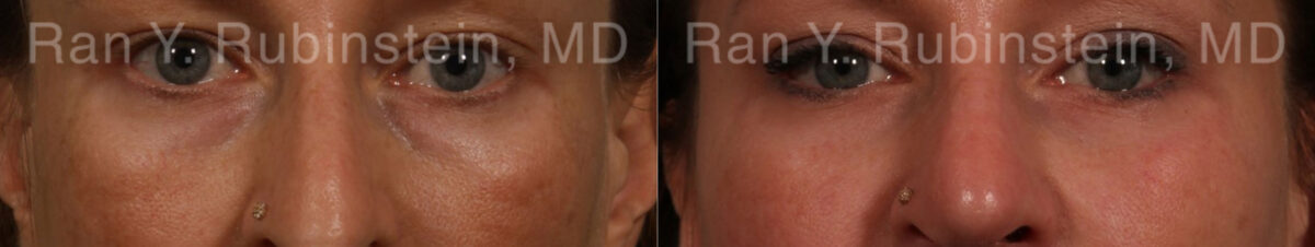 Sculptra Face Before and After Photos in Newburgh, NY, Patient 21141