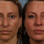 Sculptra Face Before and After Photos in Newburgh, NY, Patient 21141