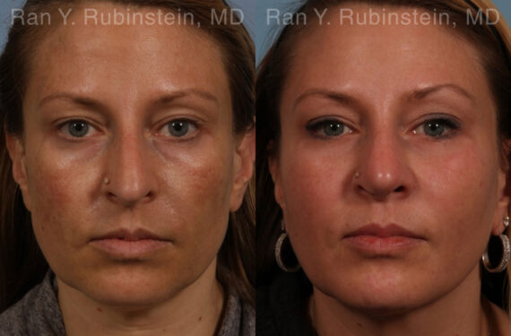 Sculptra Face Before and After Photos in Newburgh, NY, Patient 21141