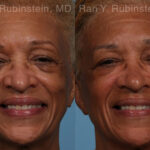 Sculptra Face Before and After Photos in Newburgh, NY, Patient 21755