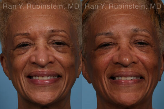 Sculptra Face Before and After Photos in Newburgh, NY, Patient 21755