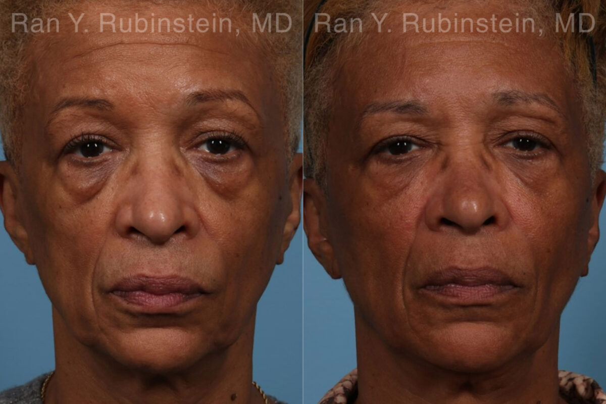 Sculptra Face Before and After Photos in Newburgh, NY, Patient 21755