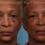 Sculptra Face Before and After Photos in Newburgh, NY, Patient 21755