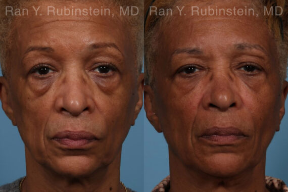 Sculptra Face Before and After Photos in Newburgh, NY, Patient 21755