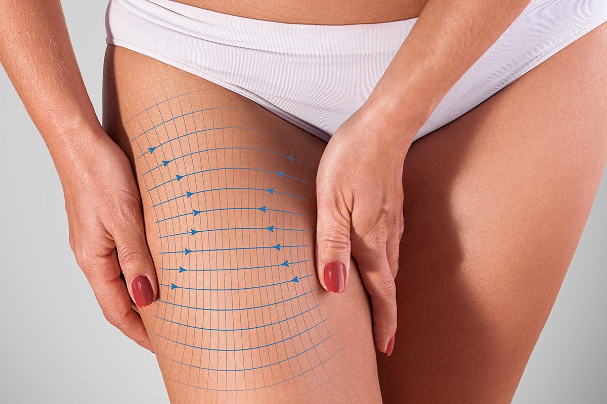 Explaining the Different Types of Thigh Lifts | Dr. Samuel Beran