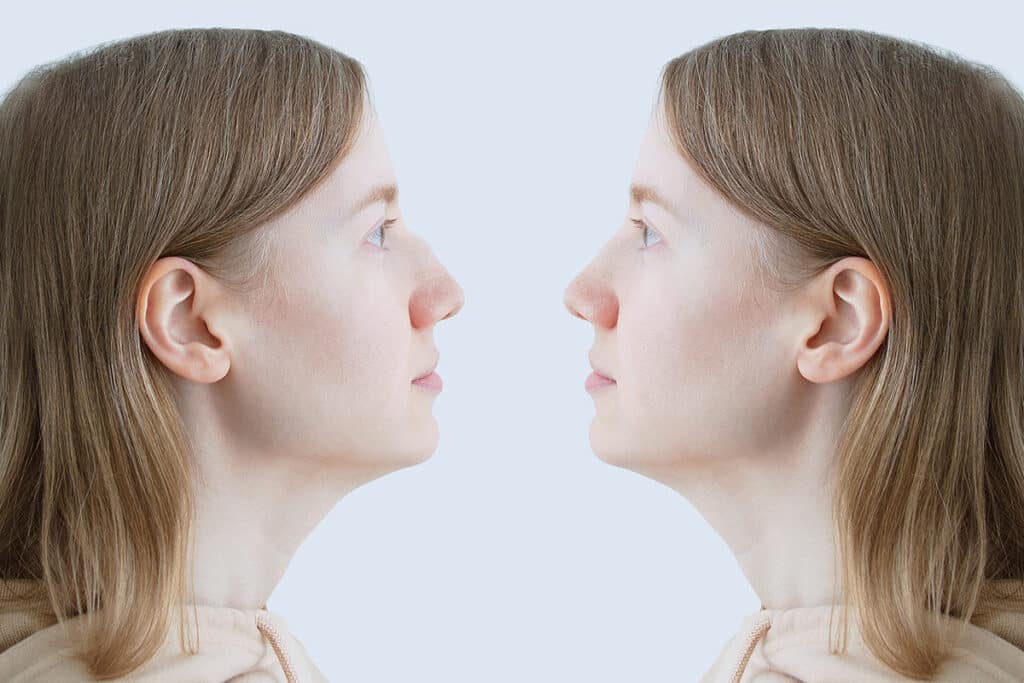 Open vs Closed Rhinoplasty Crucial Differences and Their Impact