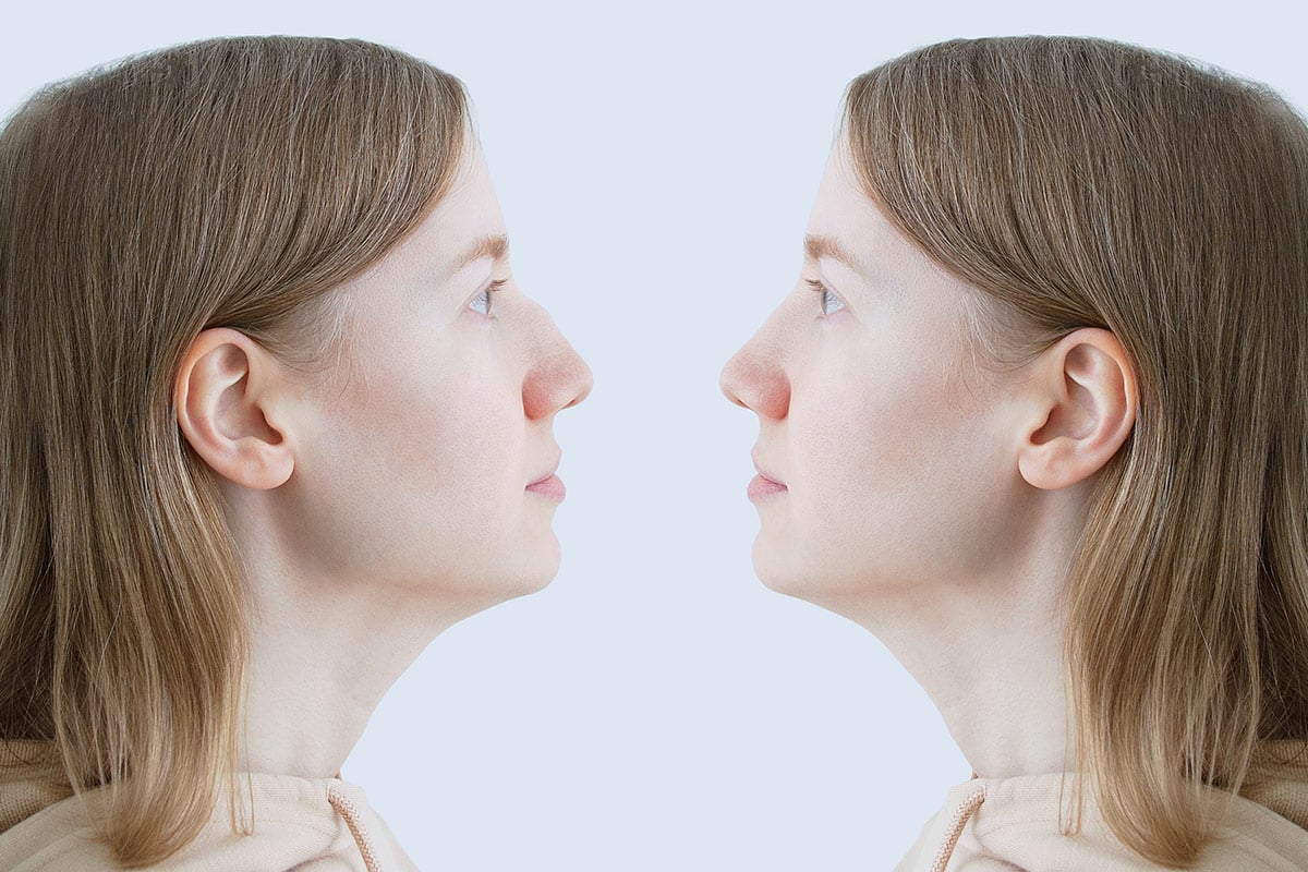 What Is The Difference Between an Open and Closed Rhinoplasty?