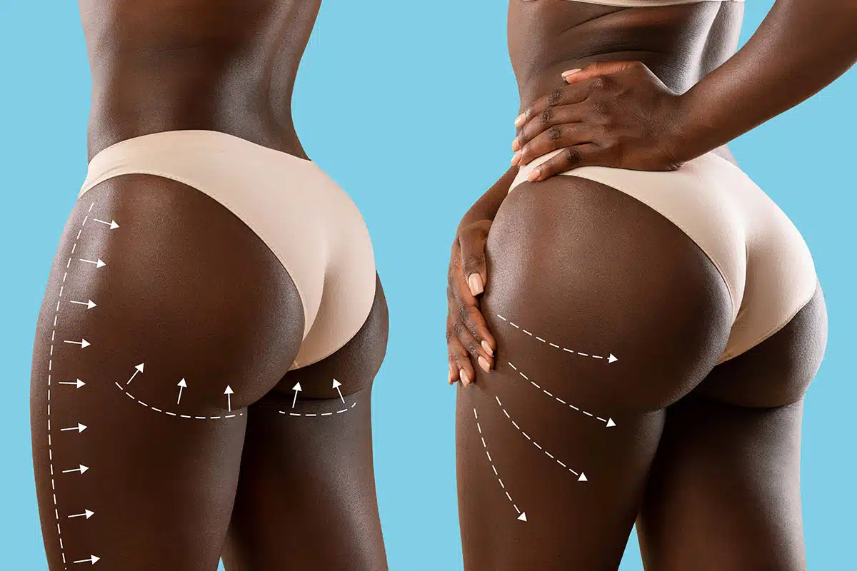 Brazilian Vs. Regular Butt Lift: Advantages, and Drawbacks