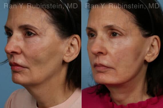 Face lift & Neck lift Before and After Photos in Newburgh, NY, Patient 24816