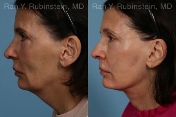 Face lift & Neck lift Before and After Photos in Newburgh, NY, Patient 24816