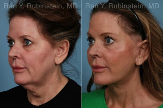 Face lift & Neck lift Before and After Photos in Newburgh, NY, Patient 24825