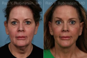 Face lift & Neck lift Before and After Photos in Newburgh, NY, Patient 24825