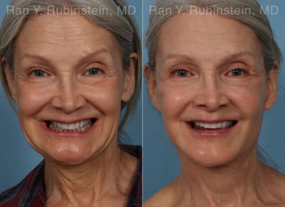 Face lift & Neck lift Before and After Photos in Newburgh, NY, Patient 24907