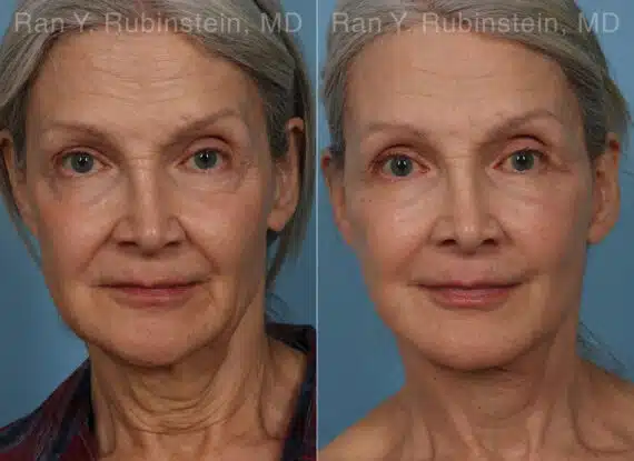 Face lift & Neck lift Before and After Photos in Newburgh, NY, Patient 24907