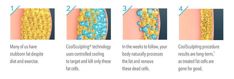 CoolSculpting uses Cryolipolysis, a remarkable new technique that employs cold temperatures to destroy deep layers of fat cells.