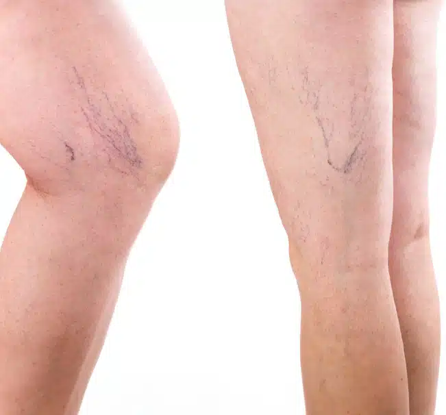 This procedure can be done in one session depending on how many spider veins need to be treated.