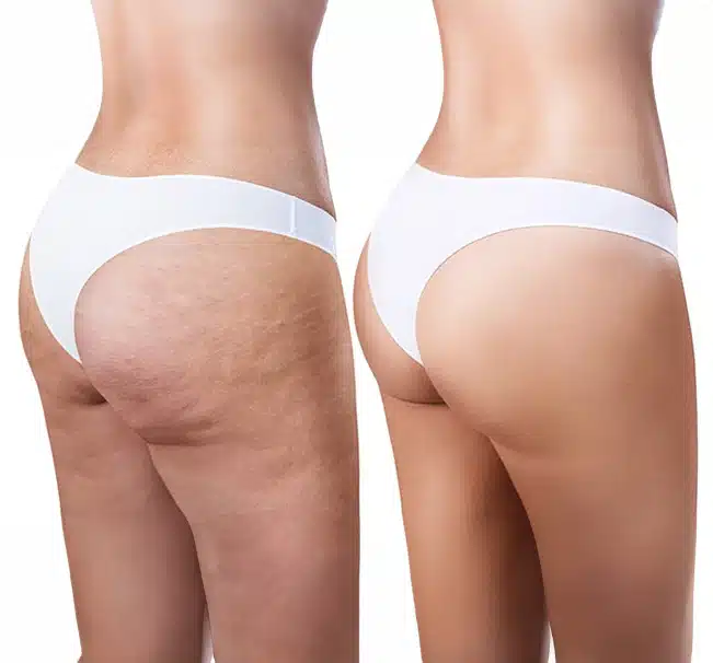 Cellulite occurs regardless of body shape or size and it even occurs in women who are thin and physically fit.