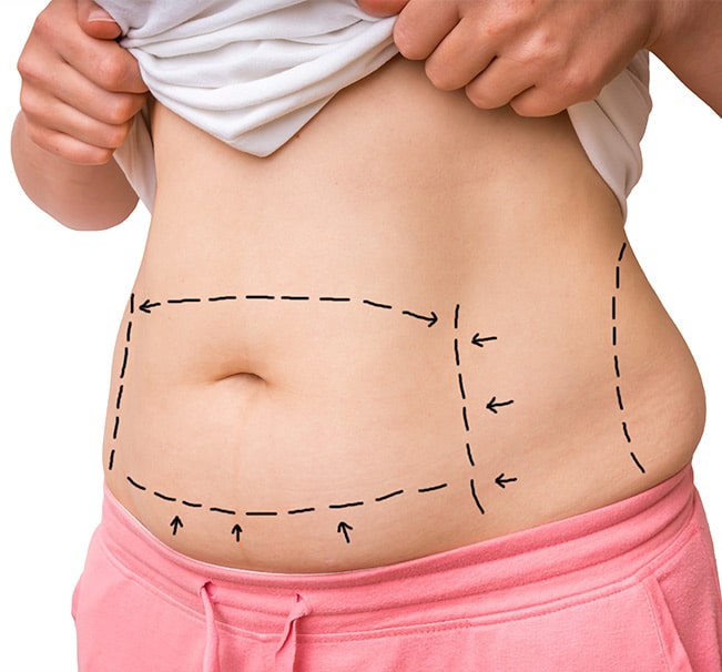 Ideal candidates for a tummy tuck procedure are those who are looking to achieve aesthetic goals for their abdominal region